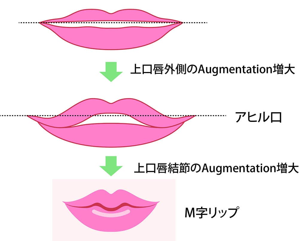 アヒル口とM字