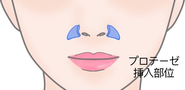 貴族手術、切開部分